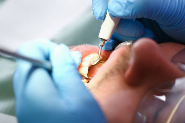 Best Chipped Tooth Repair Near Me  in Fairchild Af, WA