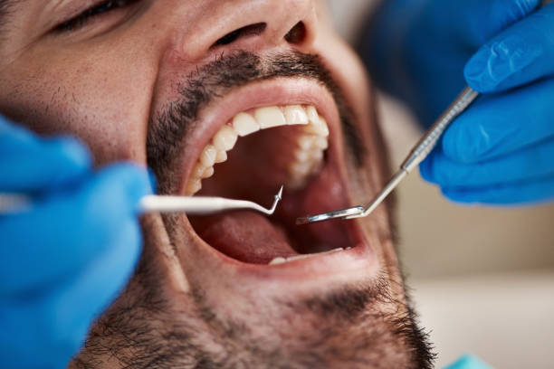 Best Teeth Whitening  in Fairchild Af, WA